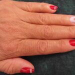 Unghie con righe orizzontali, evidenziando le linee di Beau come segno di febbre alta precedentemente affrontata.